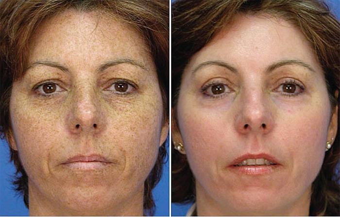 skin treatment