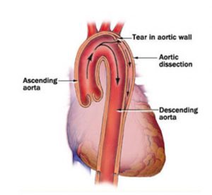 Dissecting aortic aneurysm