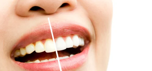 teeth-whitening-advantages