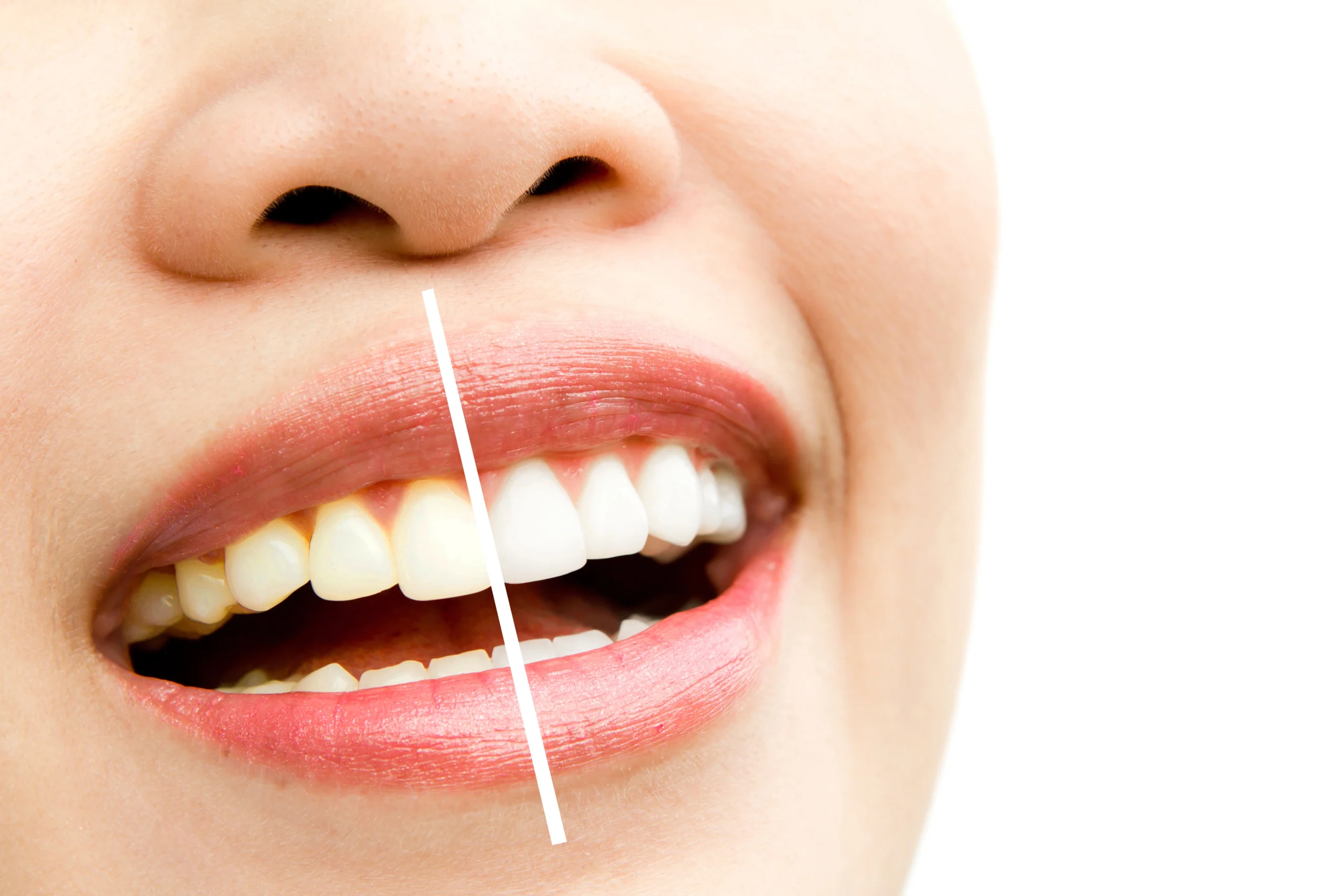 teeth-whitening-advantages