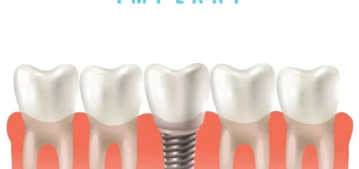 Dental Implants Clinic – Impressionz Dental Care