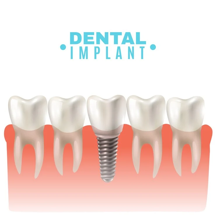 Dental Implants Clinic – Impressionz Dental Care