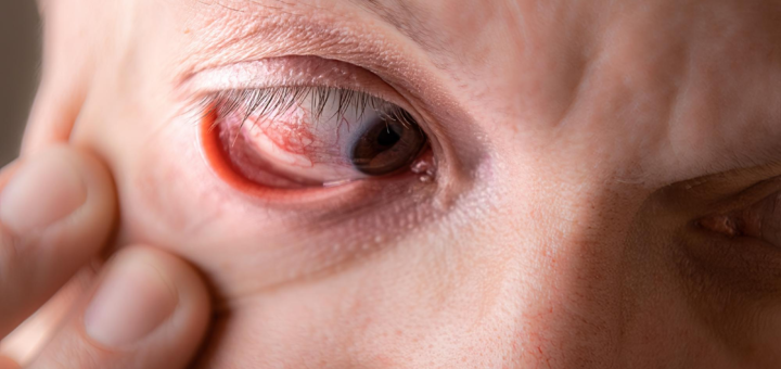 Best Treatment for Diabetic Retinopathy at SVEI